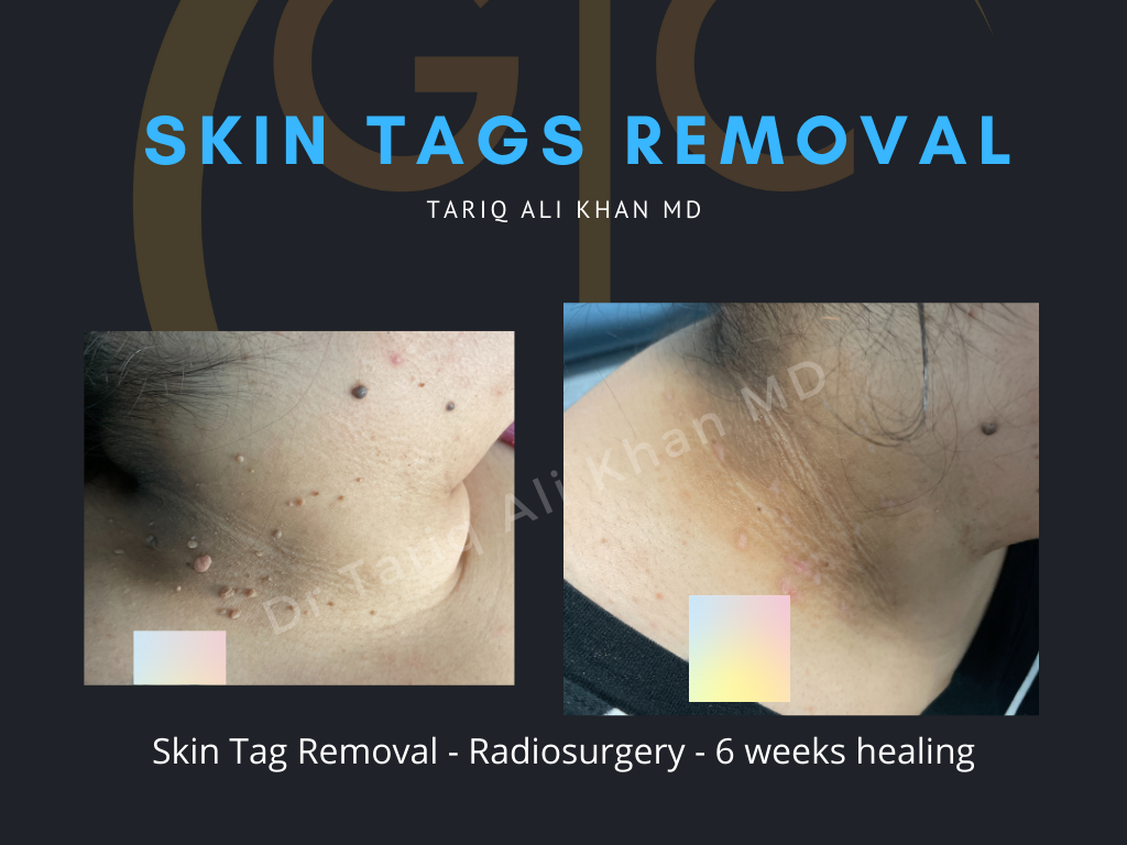 Gentle Care Laser Tustin & Long Beach Before and After picture - Skin Tags Removal